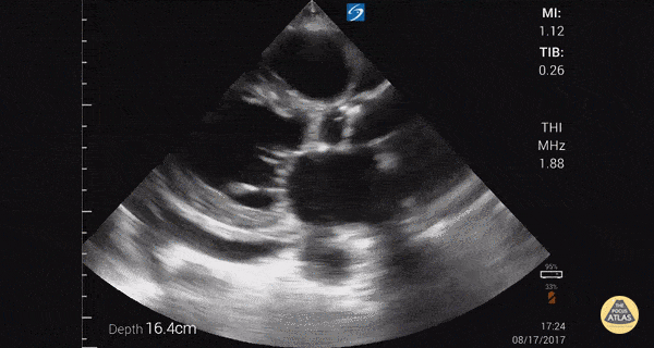 Subxiphoid PoCUS